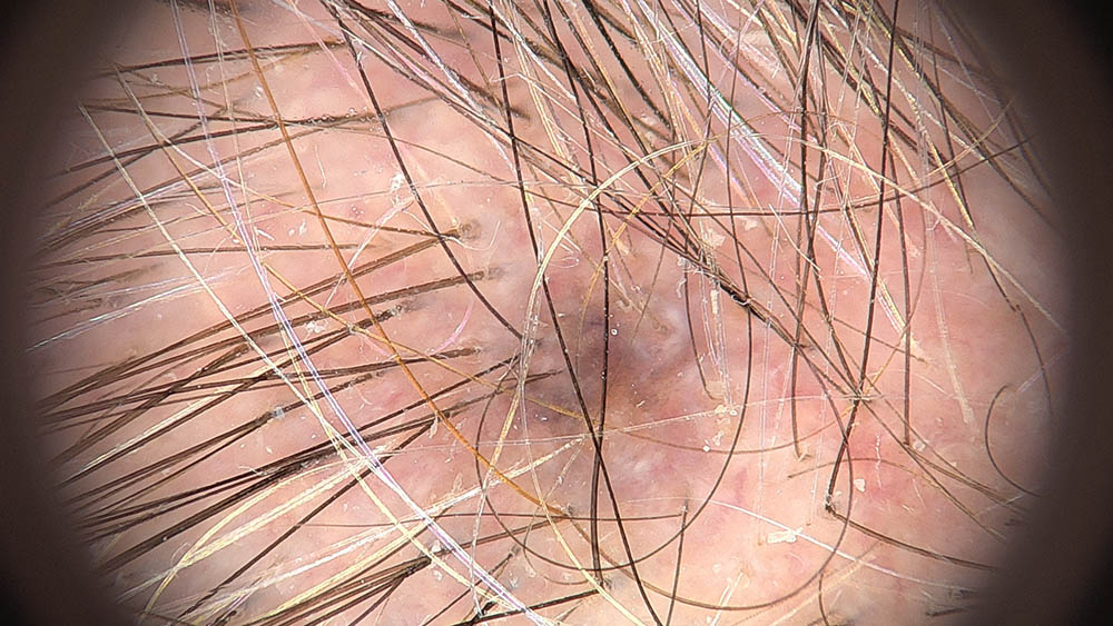 Lesion covered by hair