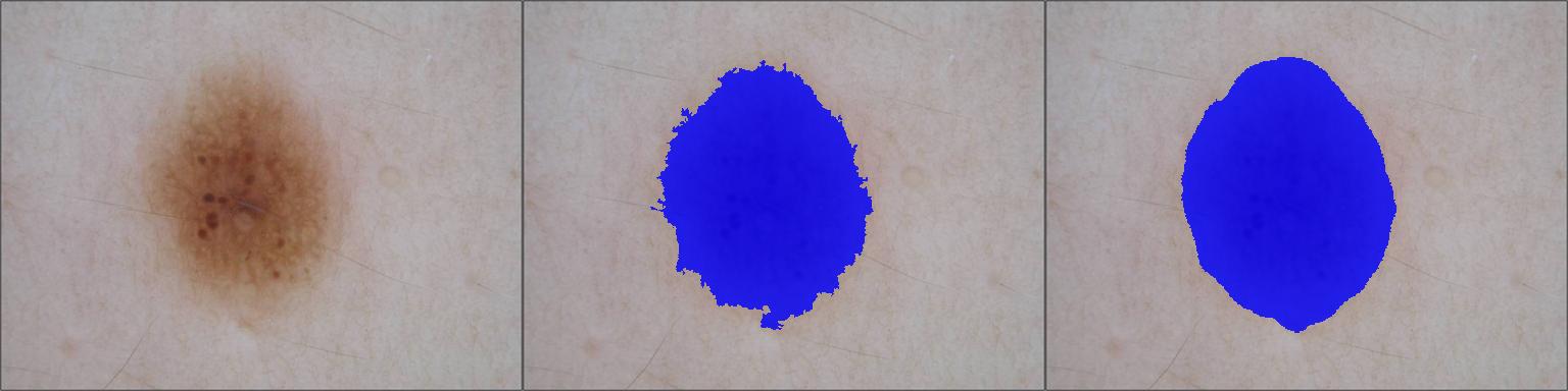 Hyperpigmentation Segmentation Example