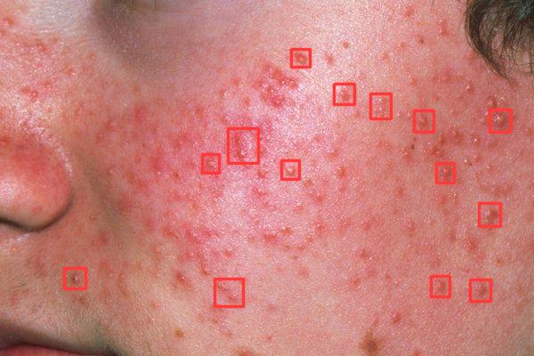 Annotated Acne