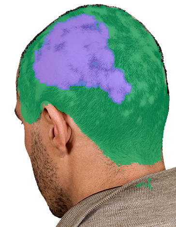 alopecia evidence