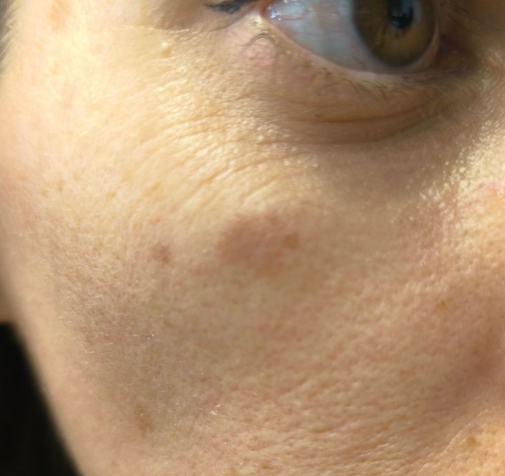 Case 1: Skin lesion showing multiple solar lentigos with a small seborrheic keratosis