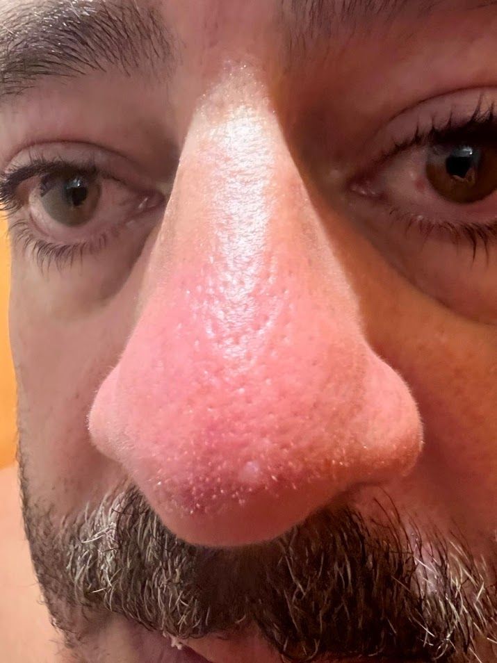 Case 2: Facial skin showing clear signs of rosacea