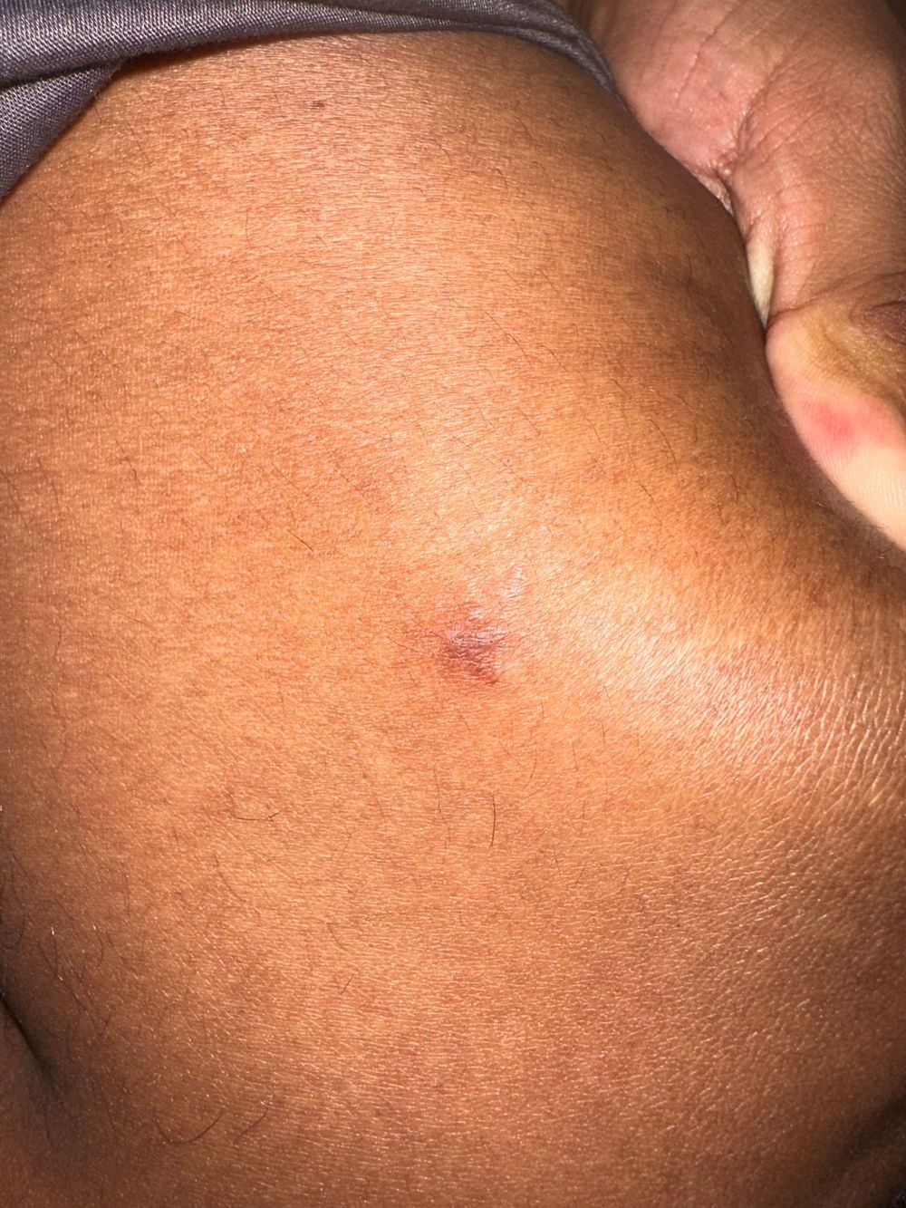 Case 3 Original: Skin lesion incorrectly diagnosed as an eye condition