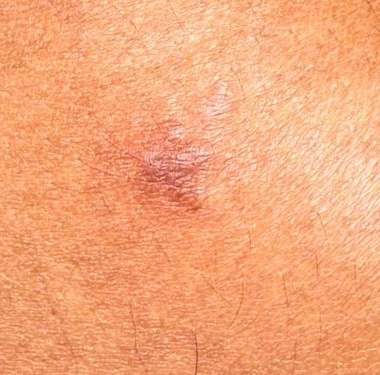 Case 3 Cropped: Same lesion with better focus