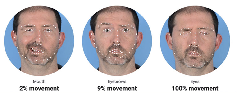 facial palsy