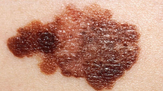 Malignant Skin Lesions (Squamous Cell Carcinoma, Melanoma, & Basal Cell Carcinoma)