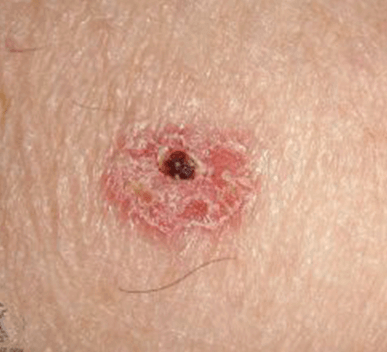 Malignant Skin Lesions (Squamous Cell Carcinoma, Melanoma, & Basal Cell Carcinoma)