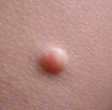 Malignant Skin Lesions (Squamous Cell Carcinoma, Melanoma, & Basal Cell Carcinoma)
